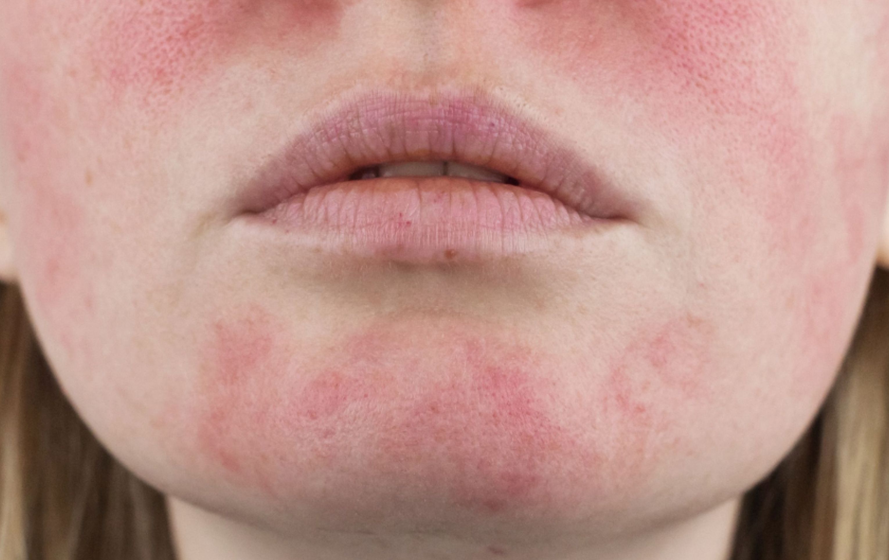 Trápí vás kuperóza nebo rosacea?