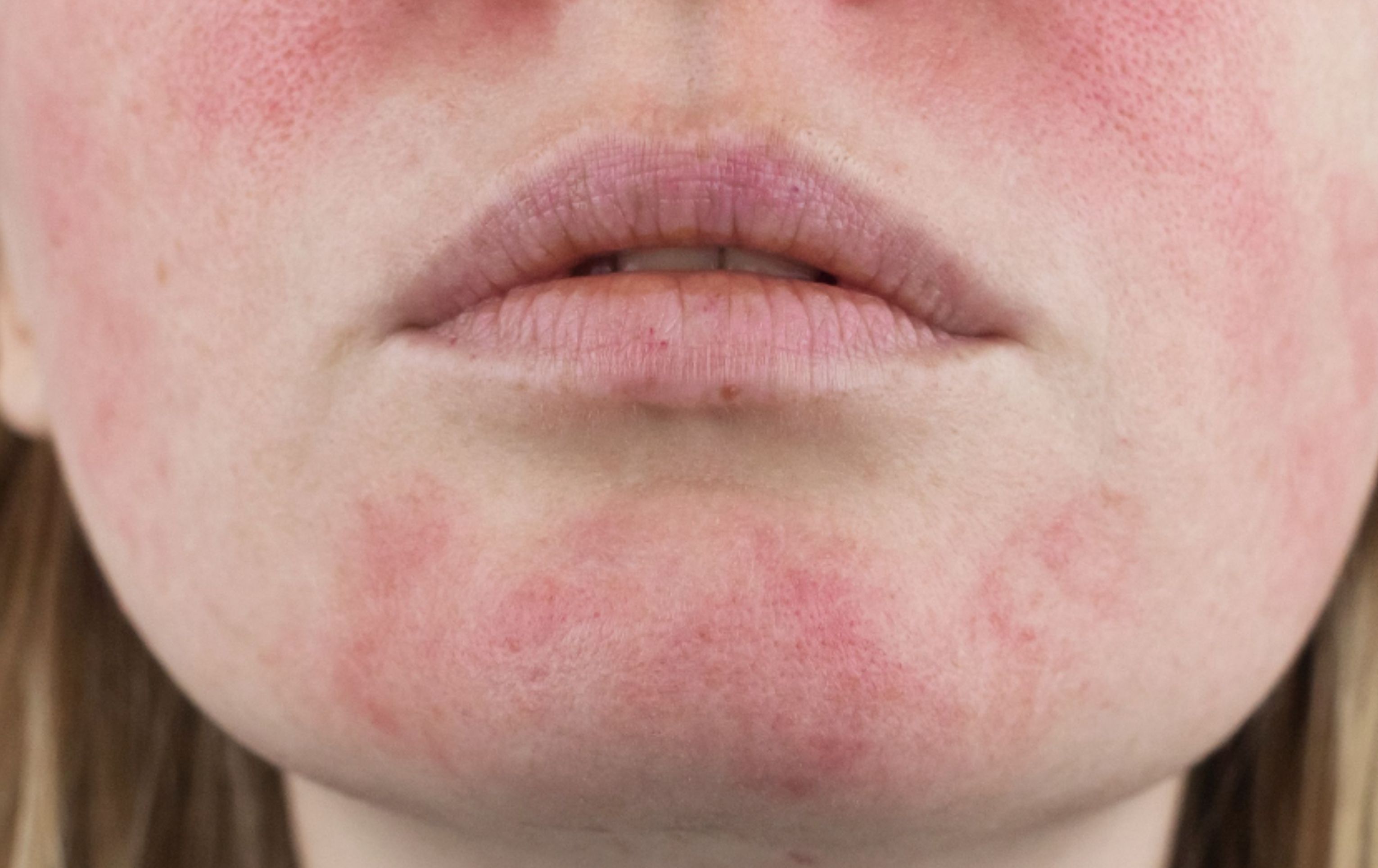 Trápí vás kuperóza nebo rosacea?